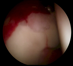 Lesión condral asociada al CFA en visión artroscópica