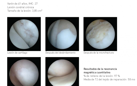 <!--:es-->Los expertos en el innovador tratamiento BST-CarGel para la regeneración de cartílago se reúnen en Madrid<!--:-->