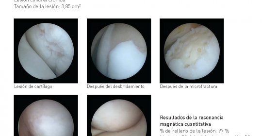 <!--:es-->Los expertos en el innovador tratamiento BST-CarGel para la regeneración de cartílago se reúnen en Madrid<!--:-->