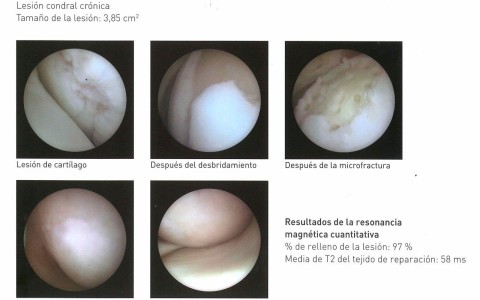 <!--:es-->España pionera en nueva técnica artroscópica para reparación de lesiones focales de cartílago en cadera, causa de artrosis en el adulto ‘joven’<!--:-->