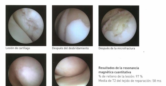 <!--:es-->España pionera en nueva técnica artroscópica para reparación de lesiones focales de cartílago en cadera, causa de artrosis en el adulto ‘joven’<!--:-->