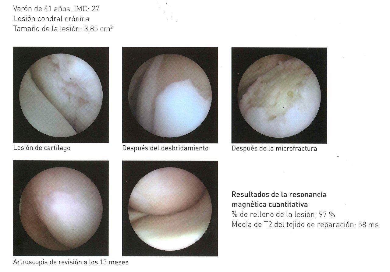 <!--:es-->España pionera en nueva técnica artroscópica para reparación de lesiones focales de cartílago en cadera, causa de artrosis en el adulto ‘joven’<!--:-->