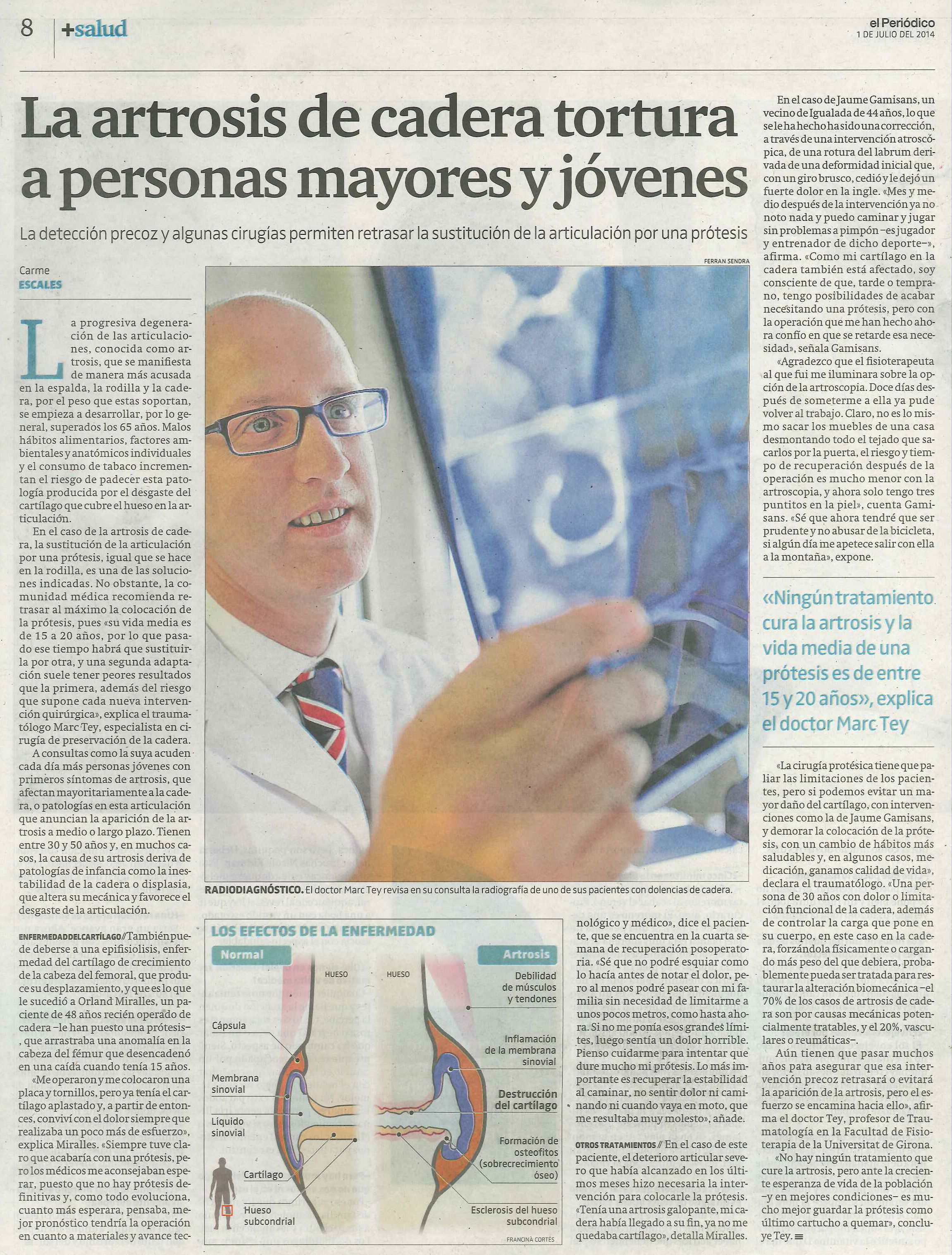 El Doctor Tey explica la cirugía de preservación de cadera a El Periódico